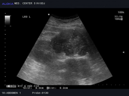 Ultrazvok ledvic - tumor ledvic najverjetneje hipernefrom (svetlocelični karcinom ledvičnih celic) 2